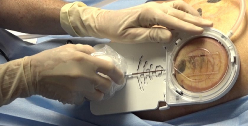 Cellulite Reduction Electro-Mechanical Device